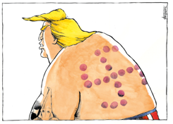 CUPPING MARKS ON TRUMP'S BACK by Michael Kountouris