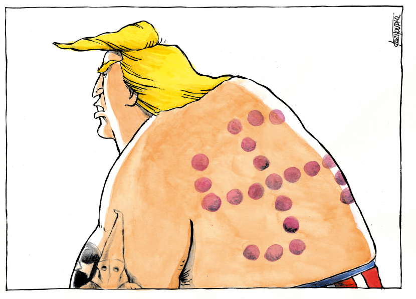 Cupping marks on Trump's back