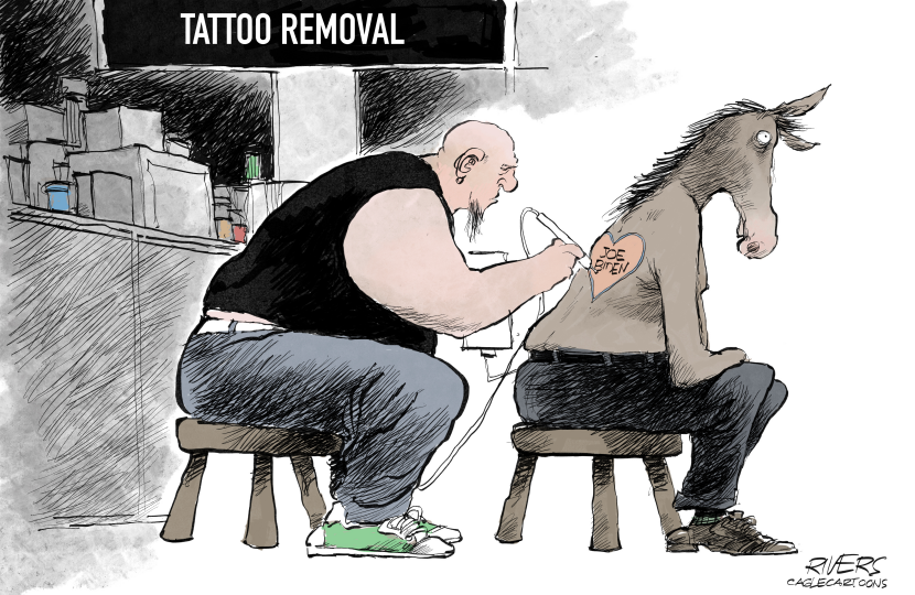 Tattoo Removal